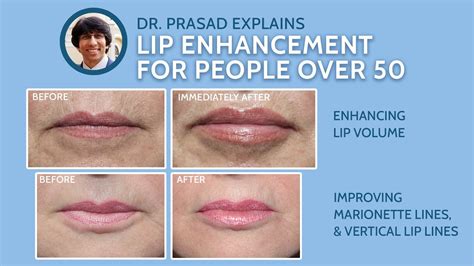 Why Lip Enhancement Over Age 50 Needs More Than Lip Fillers YouTube