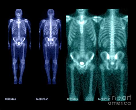 Bone Scan Photograph By Medical Body Scans Pixels