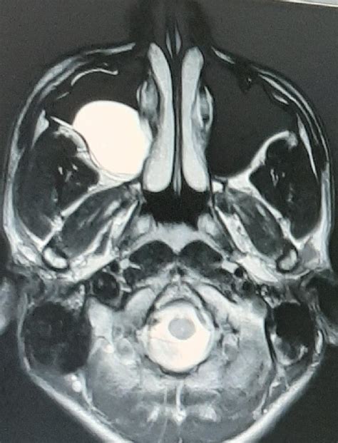 Maxillary Sinus Retention Cyst Treatment