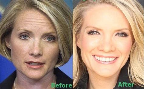 Dana Perino Plastic Surgery Facelift Nose Job Before