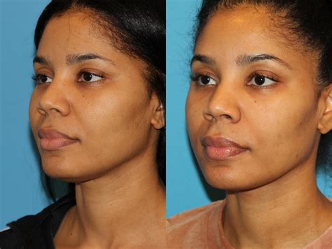 Neck Lift Submentoplasty Before And After Pictures Case 94 Atlanta