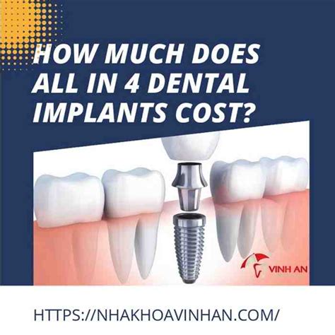 Apr 20, 2021 · cost of dental implants. How Much Does Dental Implants Cost » Dental News Network