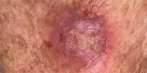Squamous Cell Carcinoma Treatment Common And Curable
