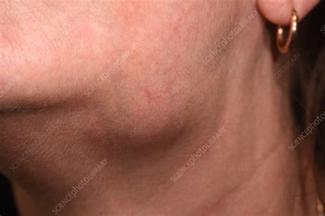 Enlarged Lymph Node Stock Image C0564082 Science Photo Library
