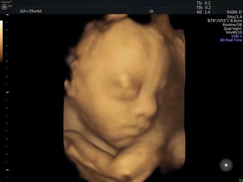 Third Trimester Scan After 28 Weeks Pregnancy Scan Perth