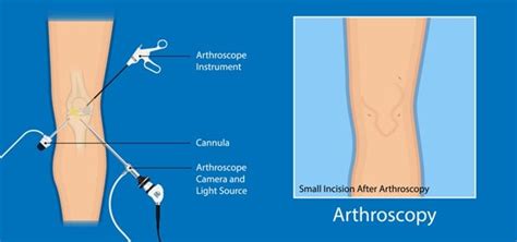 Atlanta Knee Arthroscopy Surgery