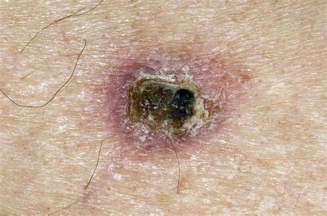 Skin Cancer On Shoulder Stock Image C0083667 Science Photo Library