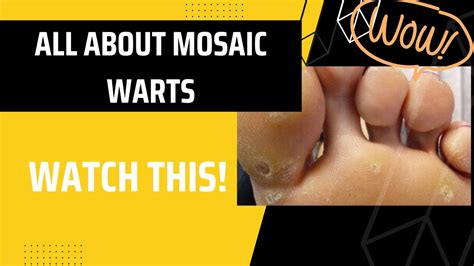 Mosaic Wart On Foot Woah Youtube