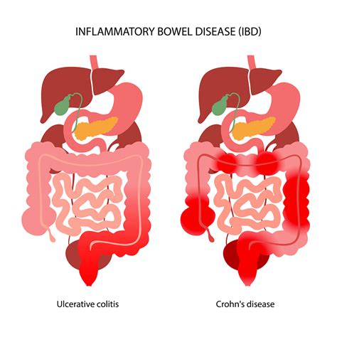 Inflammatory Bowel Disease Ibd Johns Hopkins Medicine