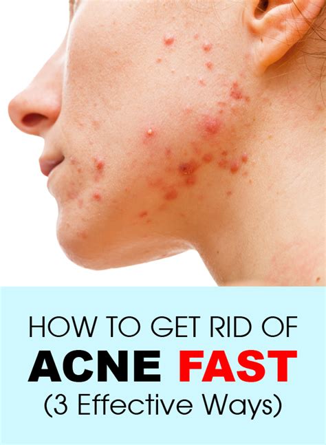 How To Get Rid Of Acne Fast 3 Effective Ways Natural Acne Treatment