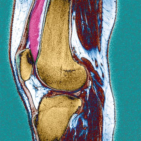 Knee Effusion Photograph By Du Cane Medical Imaging Ltd Pixels
