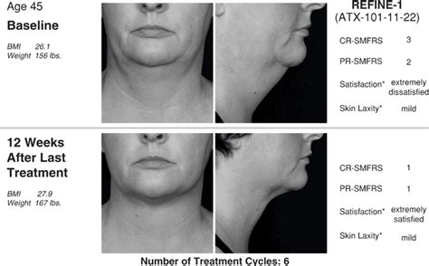 Closer To The Ideal Of Beauty Kybella Thasso