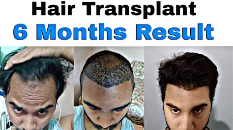 My 6 Months Hair Transplant Result Timeline Hair Transplant Before And After Youtube