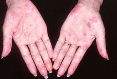Systemic Lupus Erythematosus Sle Autoimmune Diseases Articles