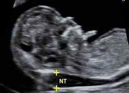 Between 11 weeks and 14 weeks of pregnancy or when your baby measures between 45mm (1.8in) and 84mm (3.3in) Ultrasound scanning in pregnancy | GP Services