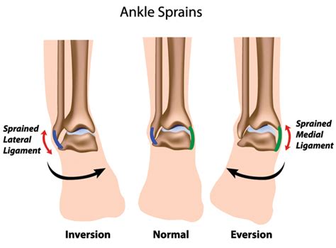 Ankle Sprain Symptoms Treatment And Recovery Time