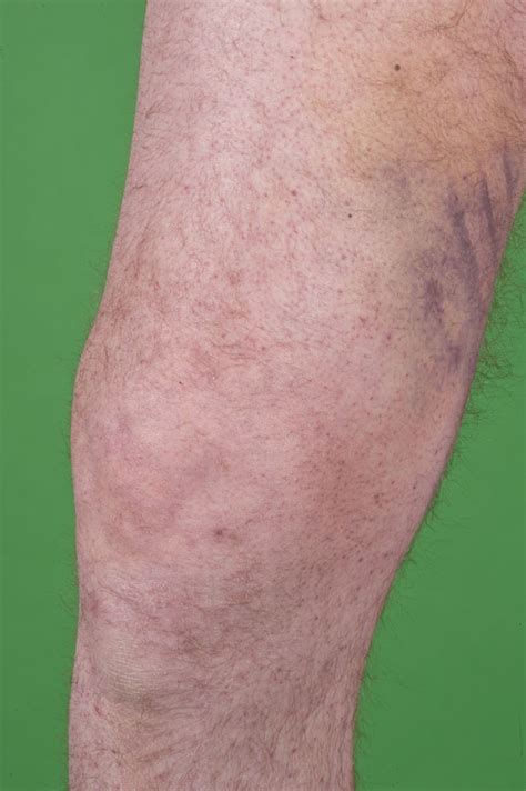 Small Bruises On The Upper Legs Download Scientific Diagram