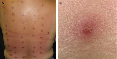 New latin, from greek, from pathos experience, emotion, passion, suffering more at pathos 1. Pathergy response to skin prick testing - Journal of ...