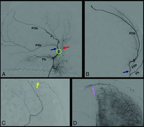 Middle Meningeal Artery Anatomy And Variations American Journal Of