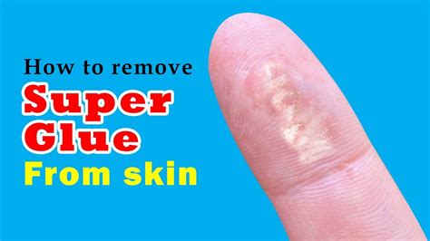 How To Remove Super Glue From Skin Easy And Effective Method Youtube