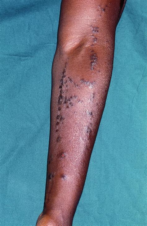 Lichen Planus Skin Disease Photograph By Dr M A Ansary Science Photo