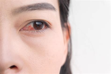 7 Pink Eye Symptoms You Shouldnt Ignore The Healthy