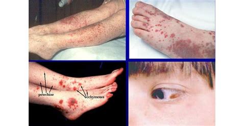 Idiopathic Thrombocytopenia Purpura Itp New