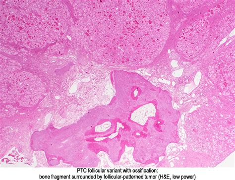 Pathology Outlines Calcification