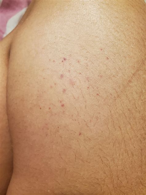 What Is This Little Red Spots On My Leg Not Bumps Ded Wasnt There