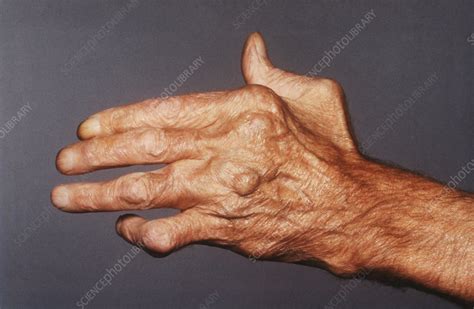 Rheumatoid Arthritis Stock Image C Science Photo Library