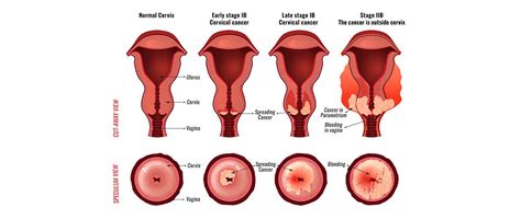 Cervical Cancer American Pregnancy Association