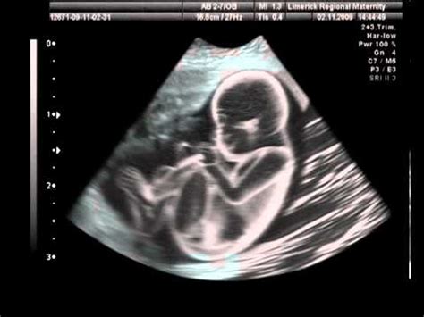 It is used to create an image of internal body structures such as tendons, muscles, joints, blood vessels, and internal organs. Dancing baby under ultrasound imaging. - YouTube