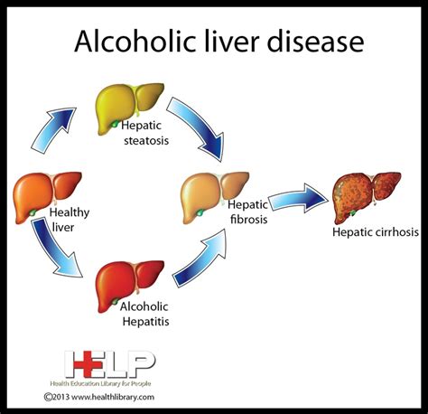Alcoholic Liver Disease Digestive Pathophysiology Pinterest