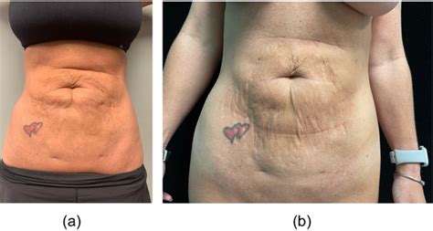 Complications And Solutions For Post Operative Liposuction Deformities