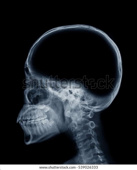 Xray Image Skull Blank Area Brain Stock Photo Edit Now 539026333
