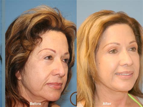Facial Fat Grafting Before And After Photos Patient 27 Dr Kevin Sadati