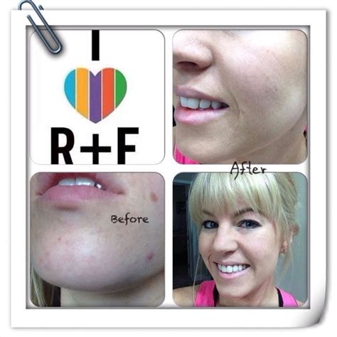 Amazing Results With Rodan And Fields Unblemish Rodan And Fields