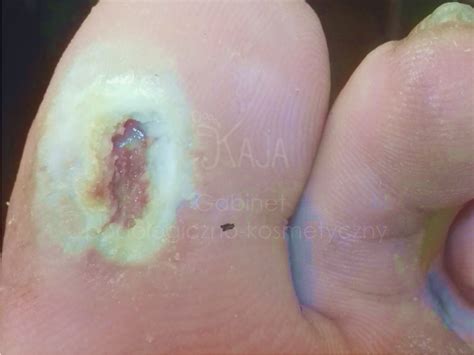 Stopa cukrzycowa to groźne powikłanie cukrzycy. Zabieg podologiczny (profilaktyka stopy cukrzycowej ...