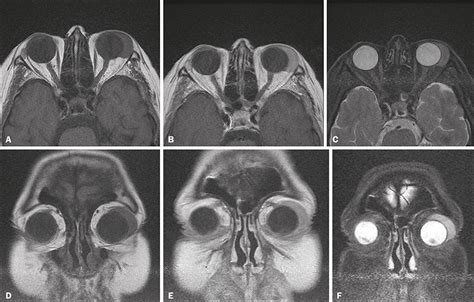 Scielo Brasil Extranodal Lymphoma Of The Head And Neck A Pictorial