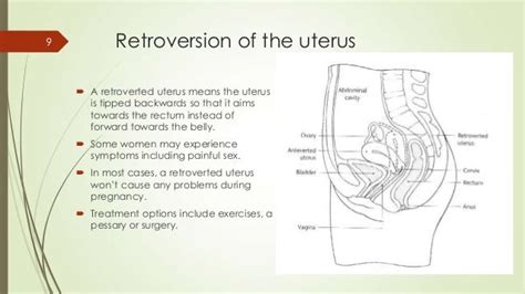 Retroverted Uterus Nhs