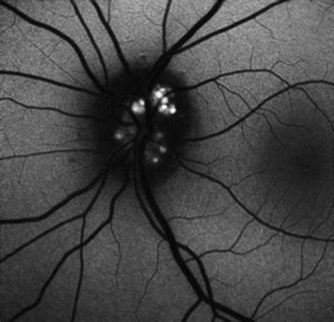 Optic Nerve Abnormalities In Children A Practical Approach Journal