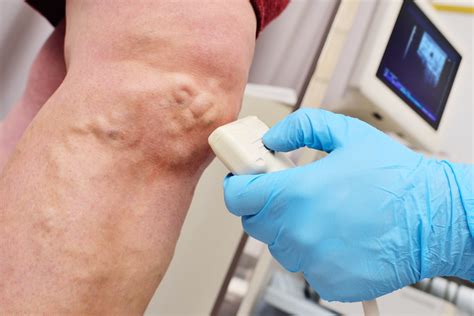 Treatment Options For Vein Disease