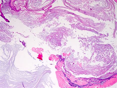 Pilonidal Cyst Histology