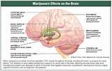 Pictures of Marijuana Overdose Symptoms