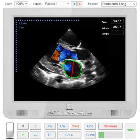 Virtual Echocardiography