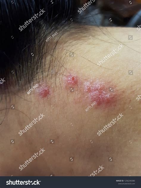 Allergy Red Rash On Neck Skin Stock Photo 1256240380 Shutterstock