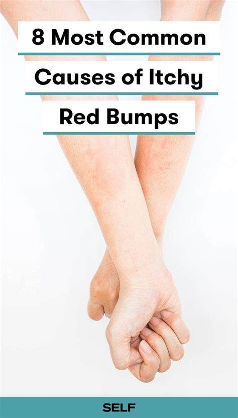Itchy Bumps On The Skin Can Be A Sign Of A Number Of Skin Issues Like