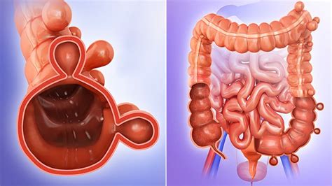 Si stima che circa il 65% degli individui, in particolare le donne, ne soffra. Diverticolite acuta - Gastroenterologo Milano - Dott.Carlo ...