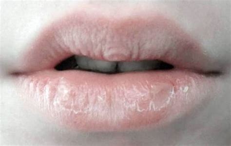 Chapped Lips Causes Treatments And Home Remedies Skincarederm