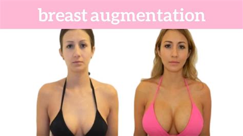 Nancy Breast Augmentation And Facial Fat Injections By Dr Garo Kassabian